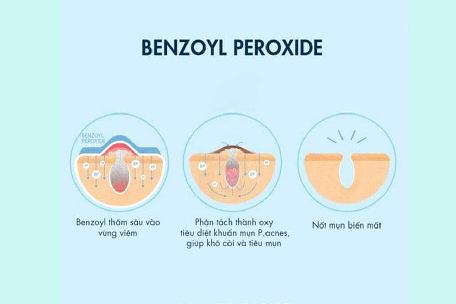 Thành phần trị mụn Benzoyl Peroxide