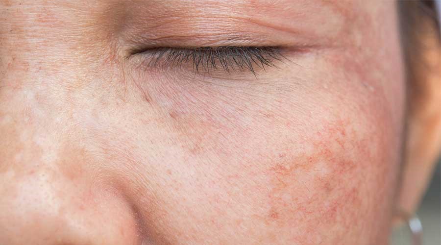 Thực hiện thay da với hóa chất mạnh có thể khiến da bị tăng sắc tố