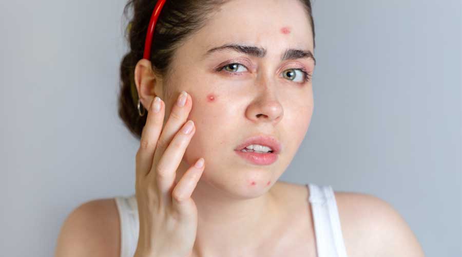 Chăm sóc da không đúng cách là một trong những nguyên nhân phổ biến gây tình trạng mụn bị viêm