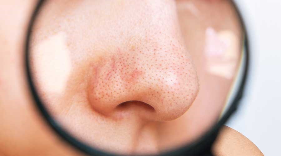 Mụn đầu đen thường xuất hiện phổ biến ở vùng da mũi