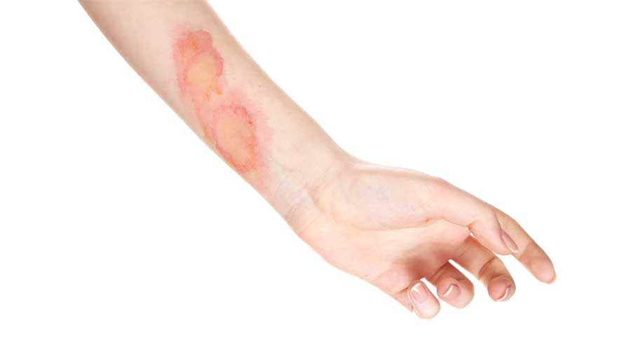 Nếu vết thương không đóng vảy hoặc có biểu hiện xuất hiện dịch mủ vàng thì có khả năng đang bị nhiễm trùng
