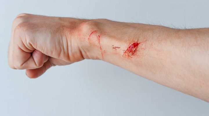 Quá trình lành vết thương hở diễn ra như thế nào? | Mediworld