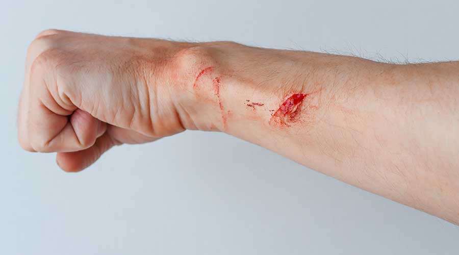 Vết thương hở thường xuất hiện khi rách da, cắt da hay trầy xước diện rộng