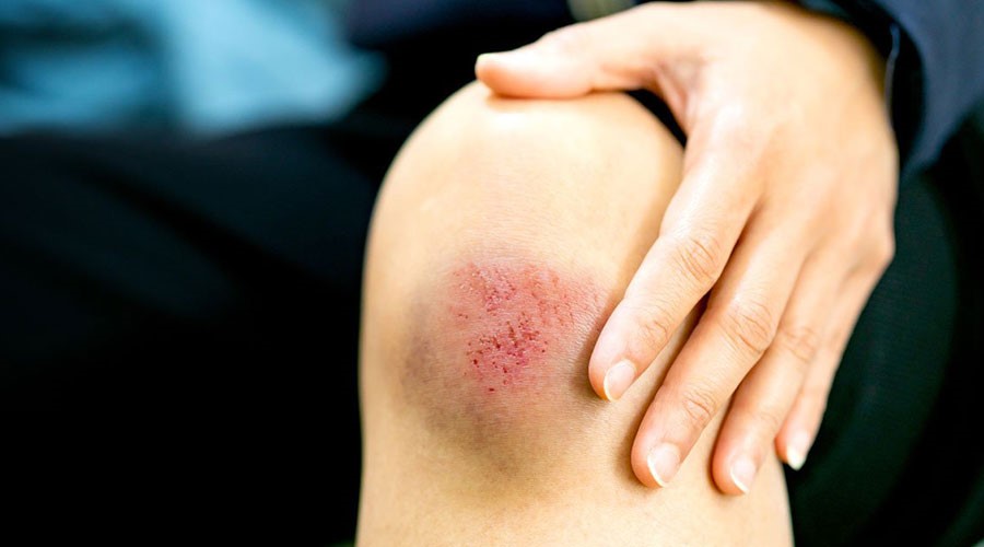 Vết thương bị nhiễm trùng thường gây phù nề, đau nhức và có thể xuất hiện các triệu chứng kèm theo như mưng mủ hay sốt