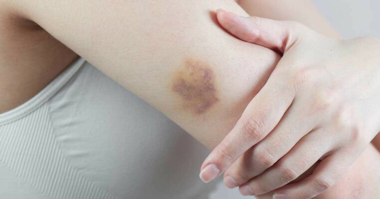 Nguyên nhân xuất hiện vết bầm tím trên da