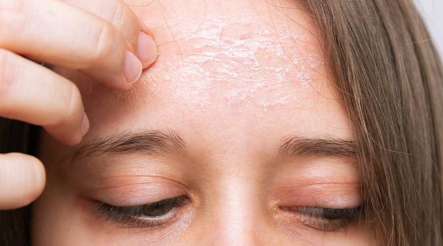 Da khô là tình trạng bị thiếu độ ẩm do mất nước ở lớp biểu bì, khiến lớp da bên ngoài thô ráp, sần sùi