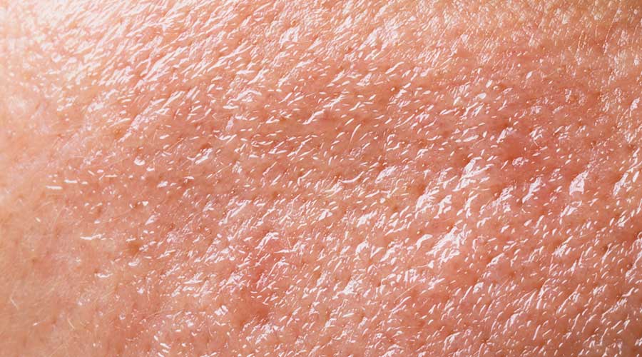 Nguyên nhân chủ yếu gây nên tình trạng này là do tuyến bã nhờn hoạt động quá mức khiến lượng dầu tiết ra bị dư thừa và tích tụ trên da