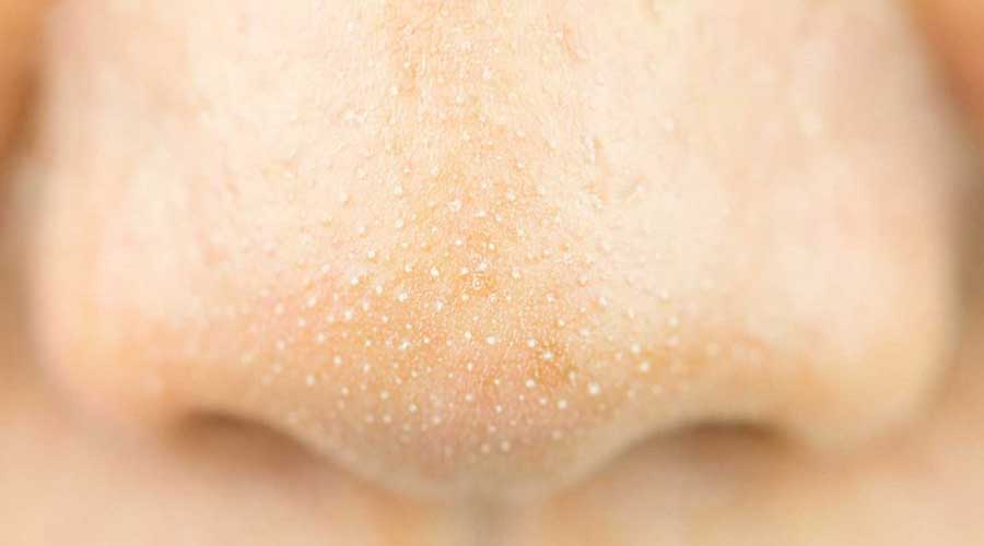 Sợi bã nhờn là những sợi nhỏ li ti, mềm, thường xuất hiện tập trung ở vùng chữ T trên khuôn mặt