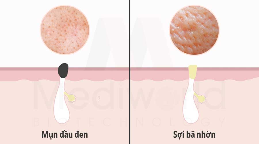 Sợi bã nhờn rất dễ nhầm lẫn với mụn đầu đen