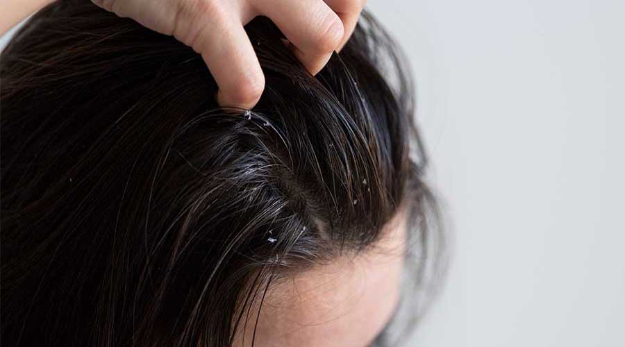 Có nhiều nguyên nhân khác nhau khiến gàu xuất hiện