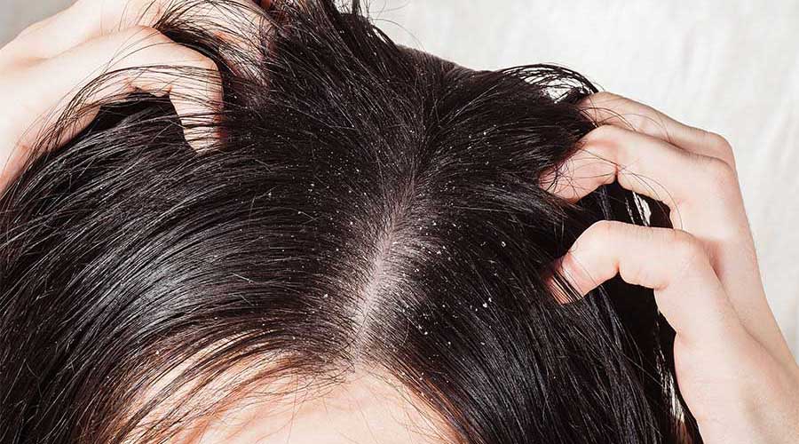 Gàu là hiện tượng các tế bào sừng trên da đầu bong ra nhanh hơn bình thường, tạo thành các mảng hoặc vảy trắng xuất hiện trên tóc hay quần áo