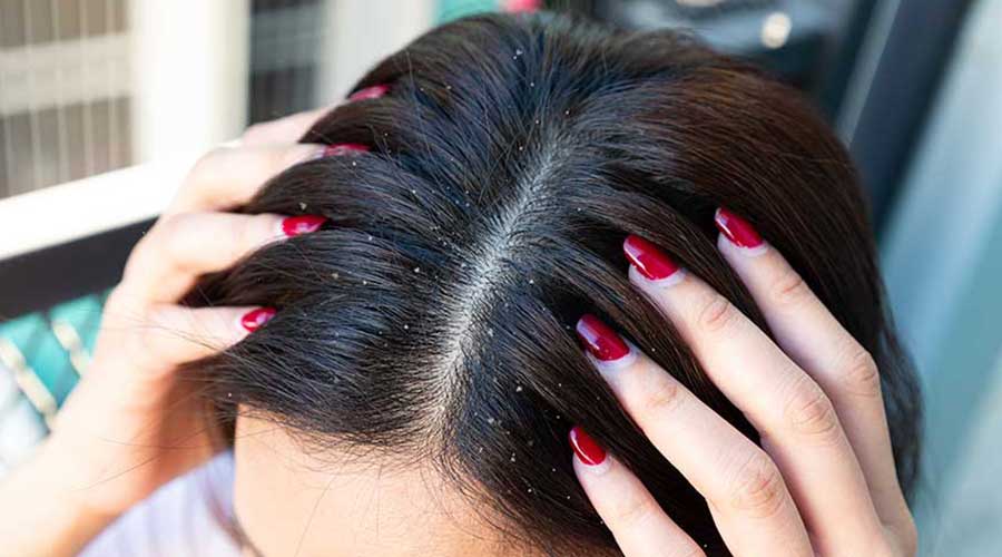Tình trạng gàu liên quan đến hệ vi sinh vật trên da đầu, tốc độ tái tạo tế bào biểu bì, tình trạng tiết dầu, cách chăm sóc,...