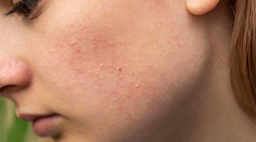 Đồng thời rất dễ nổi mụn, viêm,... khó hồi phục