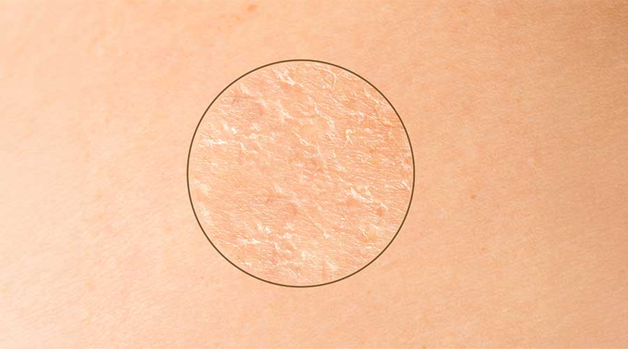 Khi lớp hàng rào bảo vệ bị tổn thương, da sẽ dễ kích ứng, khô, bong tróc hơn